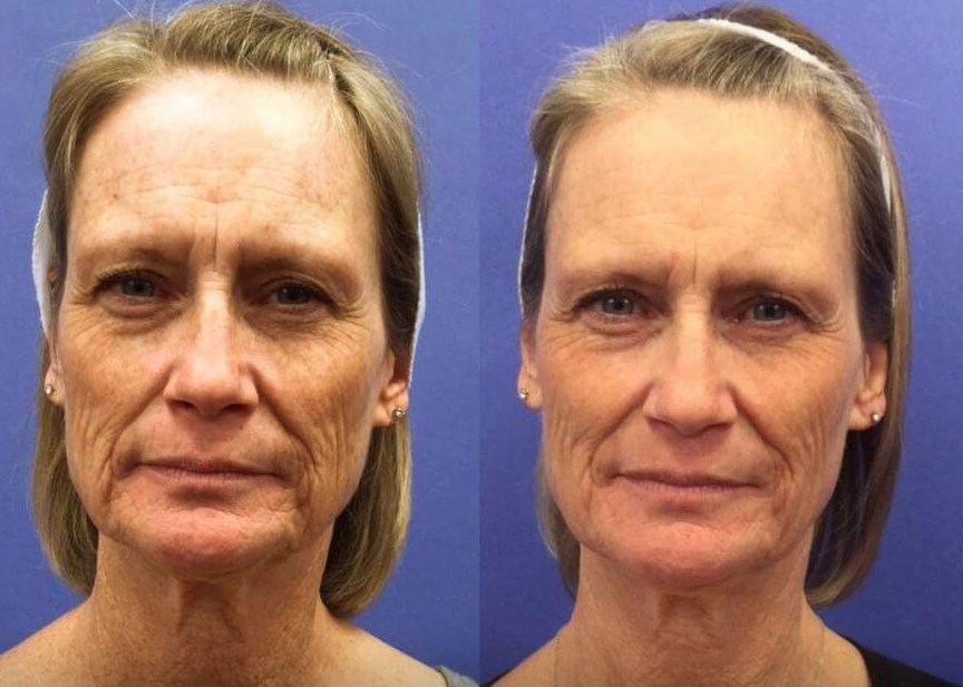 Halo Full Face Treatment